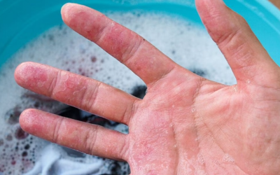 Lưu ý khi giặt quần áo đối với người bệnh chàm