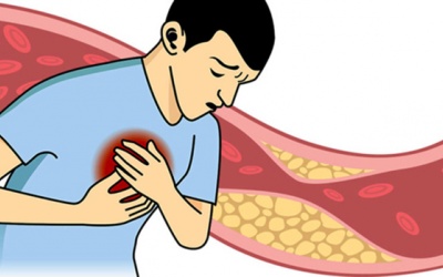 Tất tần tật những điều bạn cần biết về bệnh mỡ máu cao