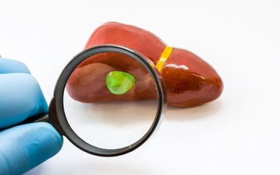 Làm sao phân biệt sỏi mật và polyp túi mật?