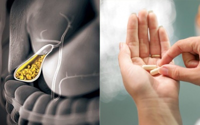 Người bị sỏi mật có uống calci được không?