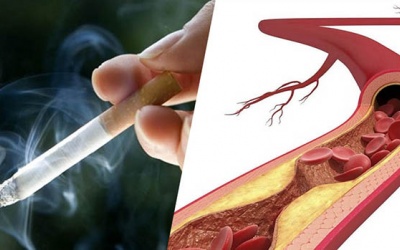 Cách phòng xơ vữa động mạch từ những thói quen đơn giản