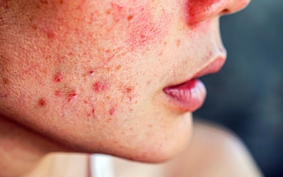 Chăm sóc da bị mụn viêm như thế nào?