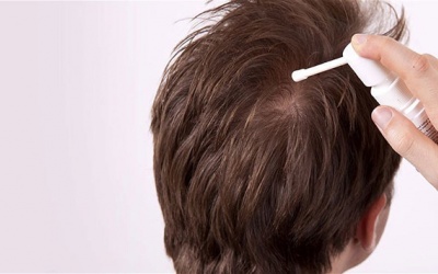 Lưu ý khi dùng minoxidil kích thích mọc tóc