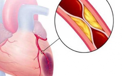 Tất tần tật thông tin bạn cần biết về hội chứng mạch vành cấp