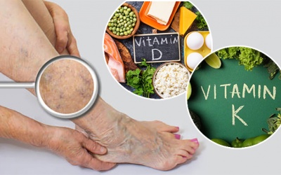 Thiếu vitamin D và K gây giãn tĩnh mạch, ảnh hưởng đến quá trình đông máu