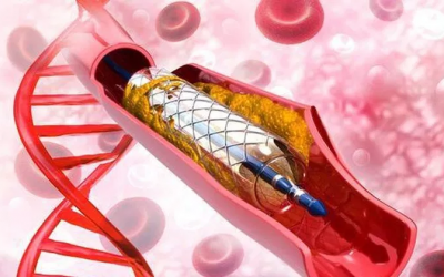 Những lưu ý sau khi đặt stent mạch vành