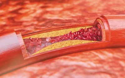 Phương pháp ngăn ngừa xơ vữa động mạch trong Tây y và Đông y