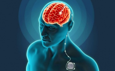 Bị Parkinson giai đoạn cuối, mổ kích thích não sâu có hiệu quả không?