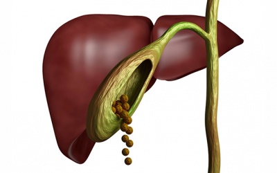 Sỏi mật 27mm điều trị thế nào, có nguy hiểm không?