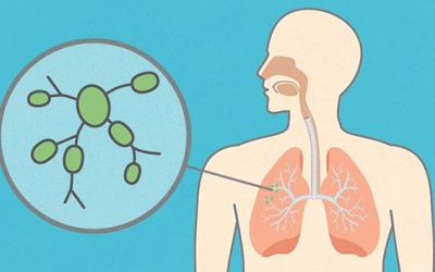 Biểu hiện và nguyên nhân ung thư phổi di căn hạch