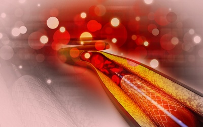 Chi phí đặt stent là bao nhiêu khi có bảo hiểm y tế?