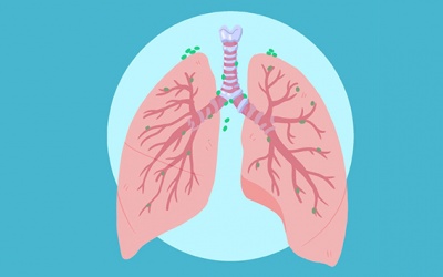 Lựa chọn điều trị cho người bệnh ung thư phổi di căn hạch