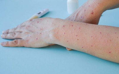 Ca bệnh đậu mùa khỉ đầu tiên tại nước ta có nguồn lây từ nước ngoài