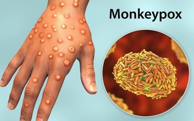 Việt Nam xuất hiện ca bệnh đậu mùa khỉ đầu tiên, Bộ Y tế chỉ đạo khẩn
