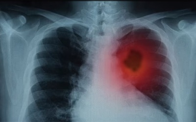 Phát hiện mới về di căn ung thư