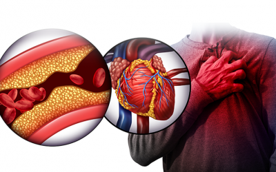 Nguy cơ xơ vữa động mạch ở người bệnh tim mạch