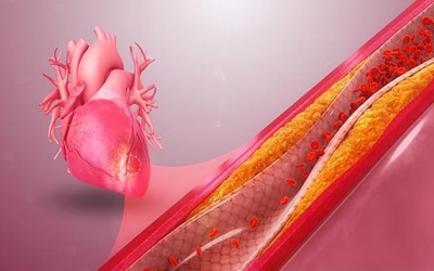 Hẹp mạch vành 60% kèm bệnh nền có phải đặt stent không?