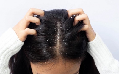 Khắc phục gàu tóc khi thời tiết hanh khô