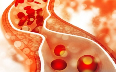 Cách hay giúp người cao tuổi phòng ngừa rối loạn lipid máu