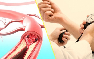 Xơ vữa động mạch ở người bị tăng huyết áp nguy hiểm thế nào?