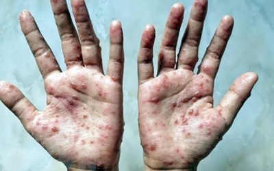 Phát hiện ca bệnh đầu mùa khỉ thứ hai ở Việt Nam