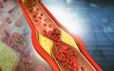 Kiểm soát mỡ máu cao, phòng ngừa biến chứng nguy hiểm