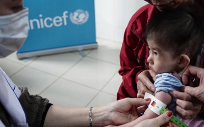 Suy dinh dưỡng cấp tính nặng ở trẻ em: Cần khẩn trương giải quyết