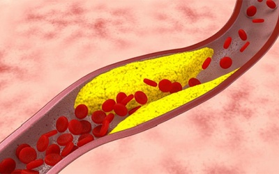 Xơ vữa động mạch ở người mỡ máu cao nguy hiểm thế nào?