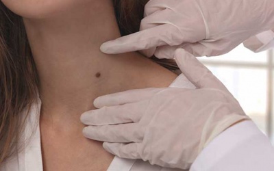 Điều trị u lành tính: Những lưu ý không thể bỏ qua