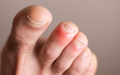 Đông đến, bị cước chân phải làm sao?