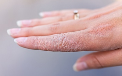 5 cách phòng ngừa khô da ngày lạnh