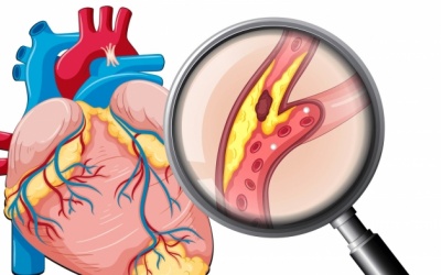 Đã đặt stent có bị tái tắc hẹp mạch vành không?