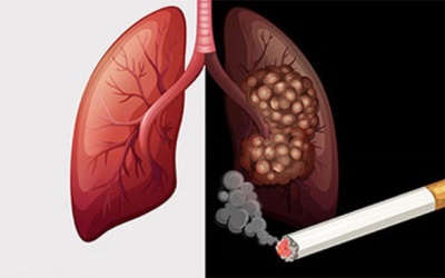 4 lầm tưởng về ung thư phổi bạn cần biết