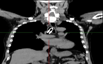 Bệnh viện Bạch Mai: Gắp thành công dị vật hiếm gặp trong đường thở của bệnh nhân