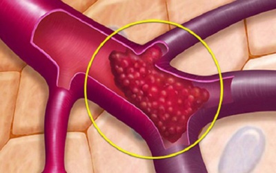 Cách phòng huyết khối do xơ vữa động mạch