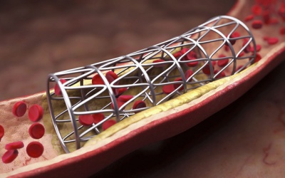 Làm sao phòng ngừa tái hẹp mạch vành sau khi đặt stent?