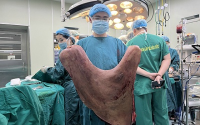 Nam thanh niên 21 tuổi mang trên mình khối u sợi thần kinh khổng lồ nặng 9kg