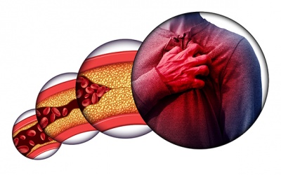 Người bệnh tim mạch cần làm gì để hạn chế nguy cơ xơ vữa động mạch?