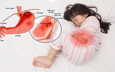 Cảnh giác với bệnh viêm loét dạ dày đang ngày càng phổ biến ở trẻ em