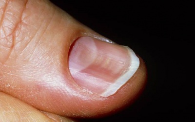 Làm sao để móng tay tôi không bị cong và gãy?