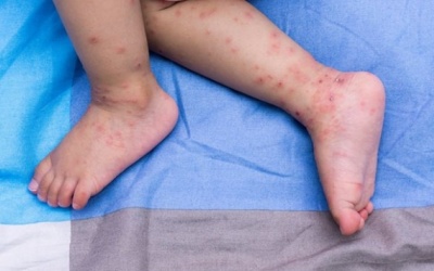 Cách xử trí khi trẻ mắc bệnh tay chân miệng