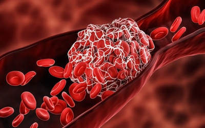 Biện pháp hỗ trợ làm tan cục máu đông, phòng ngừa đột quỵ 