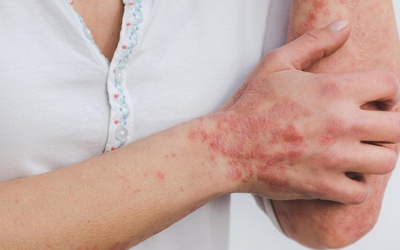 Cách chữa vảy nến hiệu quả không phải ai cũng biết