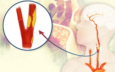 Tất tần tật những điều cần biết về bệnh động mạch cảnh