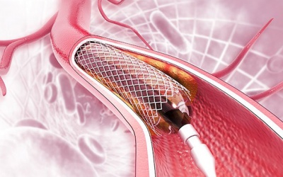 Những lưu ý sau khi đặt stent động mạch cảnh