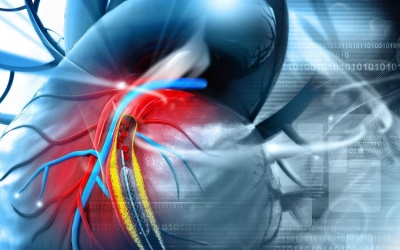 Hẹp động mạch vành: Tất cả những điều cần biết