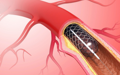 Đặt stent động mạch vành cần lưu ý những gì?
