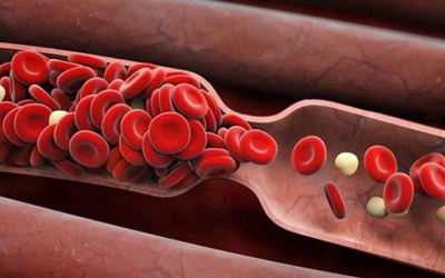 Bị mỡ máu cao uống thuốc gì để nhanh cải thiện bệnh?