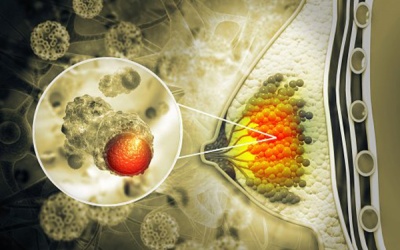 Sưng đau vú, vào viện phát hiện ung thư vú thể viêm hiếm gặp