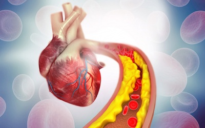 Những điều cần biết về xơ vữa động mạch vành